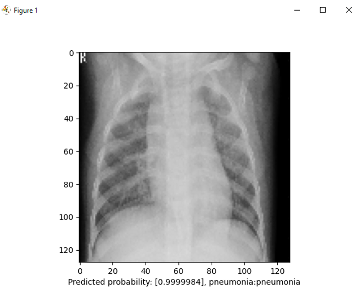 Positive Case of Pneumonia
